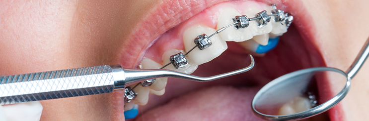 Orthodontics-in-Reading